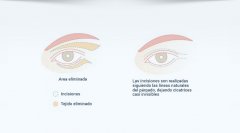 Blefaroplastia - Dres. Duarte-Serret
