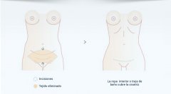 Abdominoplastia. Cirugía del abdomen - Dres. Duarte-Serret