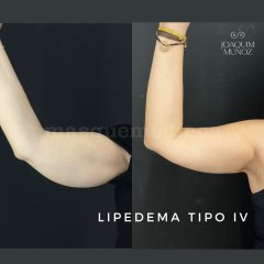 Lipedema tipo IV - Joaquim Muñoz