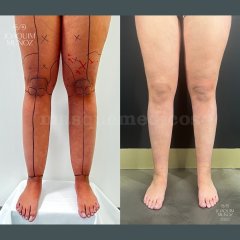 Lipedema - Joaquim Muñoz