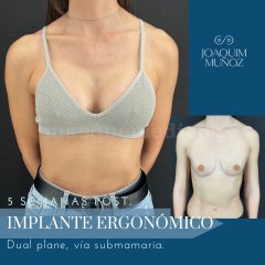 Implante ergonómico - Joaquim Muñoz