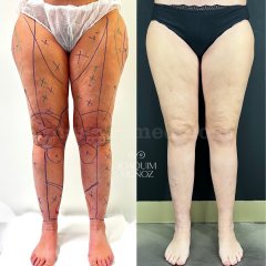 Lipedema Tipo III - Joaquim Muñoz