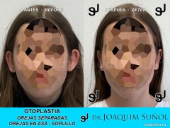 Otoplastia de orejas prominentes o separadas - Joaquim Suñol