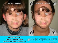 Otoplastia de orejas prominentes o separadas - Joaquim Suñol