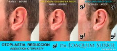 Reduccion del tamaño de las Orejas - Joaquim Suñol