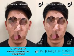 Otoplastia de orejas prominentes o separadas - Joaquim Suñol