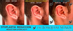 Reduccion del tamaño de las Orejas - Joaquim Suñol