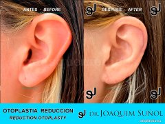 Reduccion del tamaño de las Orejas - Joaquim Suñol