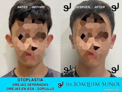 Otoplastia de orejas prominentes o separadas - Joaquim Suñol