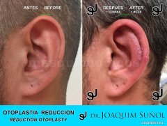 Reduccion del tamaño de las Orejas - Joaquim Suñol