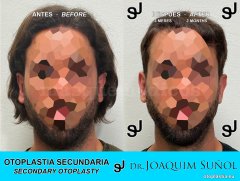 Otoplastia de orejas prominentes o separadas - Joaquim Suñol