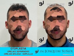 Otoplastia de orejas prominentes o separadas - Joaquim Suñol