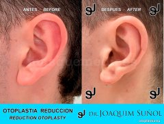 Reduccion del tamaño de las Orejas - Joaquim Suñol