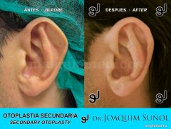 Otoplastia Secundaria - Joaquim Suñol