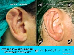 Otoplastia Secundaria - Joaquim Suñol