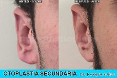 Otoplastia Secundaria - Joaquim Suñol