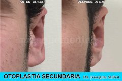 Otoplastia Secundaria - Joaquim Suñol