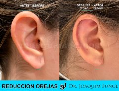Reduccion del tamaño de las Orejas - Joaquim Suñol