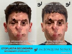 Otoplastia Secundaria con Reduccion del tamaño de las Orejas - Joaquim Suñol