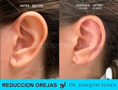 Reduccion del tamaño de las Orejas - Joaquim Suñol