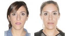 Clase III y asimetría facial - Federico Hernández Alfaro