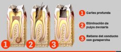 Endodoncia - Clínica Dental Jaume Nin