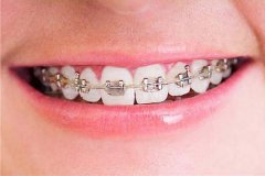 Ortodoncia - Clínica Dental Jaume Nin