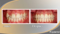 Ortodoncia estética - Clínica Dental Propdental Encants