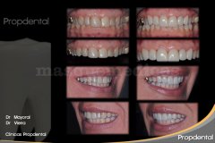 Carillas de porcelana sin tallar el diente - Clínica Dental Propdental Encants