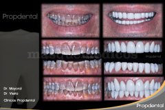 caso carillas dentales - Clínica Dental Propdental Encants