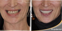 caso de implantes dentales - Clínica Dental Propdental Encants