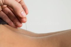 Acupuntura en fisio a casa - Fisio a Casa