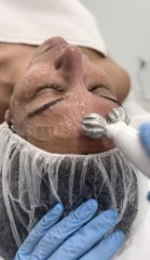 FISIO ESTÉTICA ONA Hidrodermoabrasión 4 en 1 - AKRO: Medicina, fisioterapia y readaptación