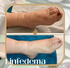 Drenaje linfático Brasileño Renata França - Centro Masaje Drenaje Linfático Manual Renata França