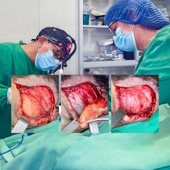 lipoma en region fronto-parietal - Eduardo Alvarado