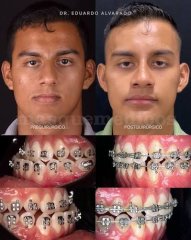 Asimetria facial - Eduardo Alvarado