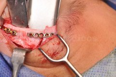 tumor de orbita en paciente pediatrico - Eduardo Alvarado
