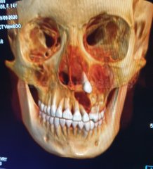 Tumor Odontogenico Adenomatoide (T.O.A.) - Eduardo Alvarado
