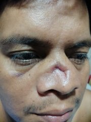 fractura nasal complicada - Eduardo Alvarado