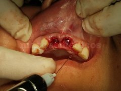 implantes dentales - Eduardo Alvarado