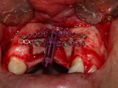 distraccion osteogenica - Eduardo Alvarado