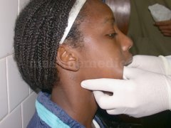 luxacion mandibular - Eduardo Alvarado