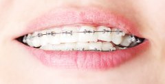 Ortodoncia - Clínica de Prado Dental
