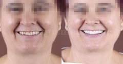Carillas dentales  - Clínica Dental Bernabeu
