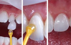 Carilla sin tallado dental - Clínica Dental Bernabeu