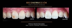 Eliminación de manchas - Clínica Dental Bernabeu