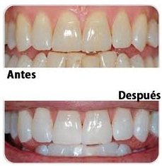 Blanqueamiento dental - Clínica Dental Doctores Gross