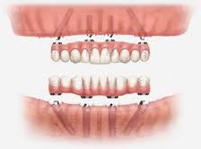 Implantes dentales - Clínica Dental Doctores Gross