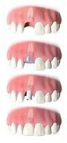 Implantes Unitarios - Clínica Dental Jorge del Corral