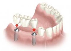 Puente soporto-implantado - Clínica Dental Jorge del Corral